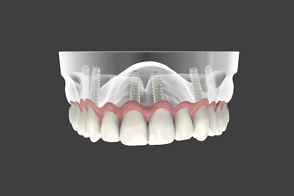 Are Implant Supported Dentures Permanent from Sonoran Desert Dentistry in Scottsdale, AZ