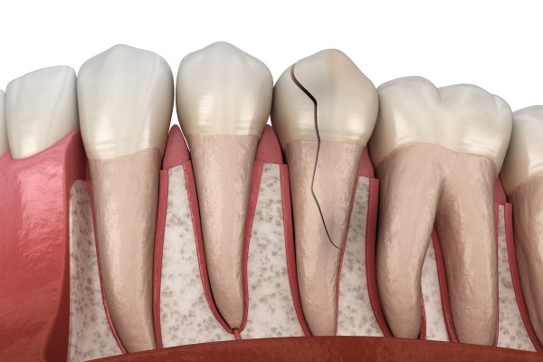 Crowns, Fillings, Or Bridges? Treatment Options For A Broken Tooth