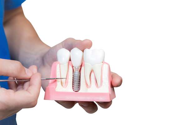 Can You Get Dental Implants if You Have Gum Disease from Sonoran Desert Dentistry in Scottsdale, AZ