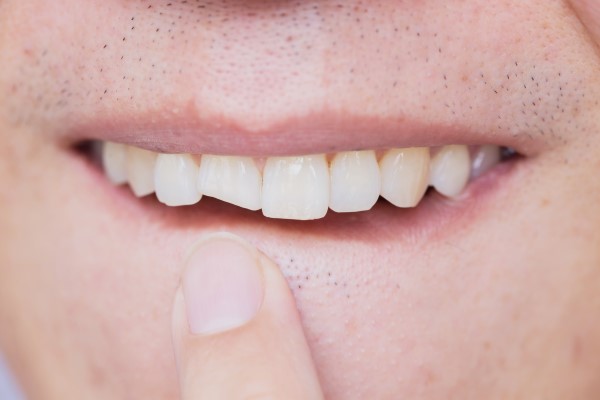 Restorative Options For A Chipped Tooth