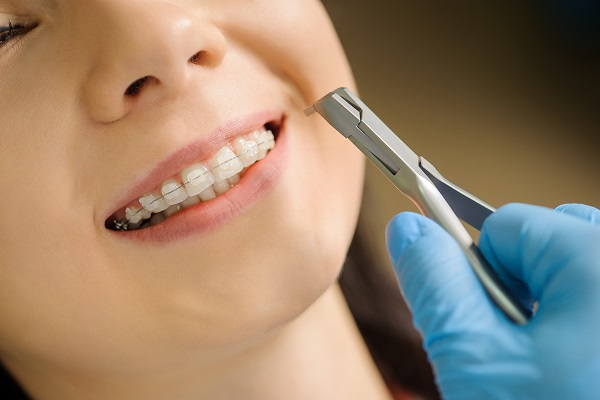 Common Clear Braces Maintenance And Aftercare