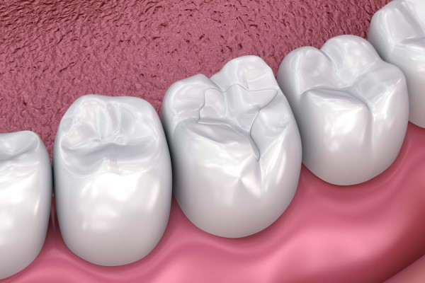 What Are Composite Fillings Made Of?