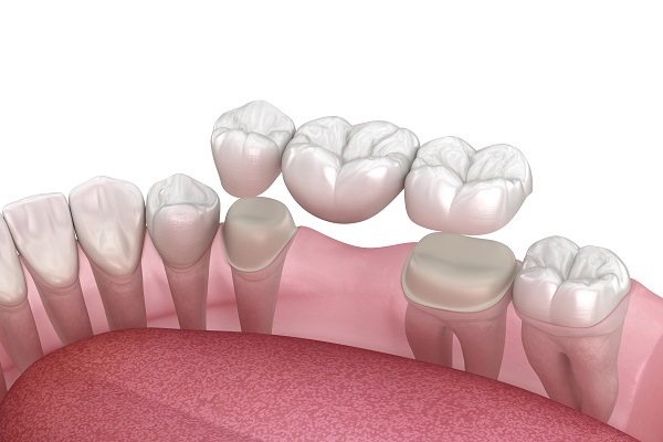 When Should You Choose A Dental Bridge Over An Implant?