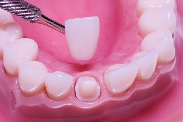 How Does A Dentist Prepare A Tooth For A Dental Crown?