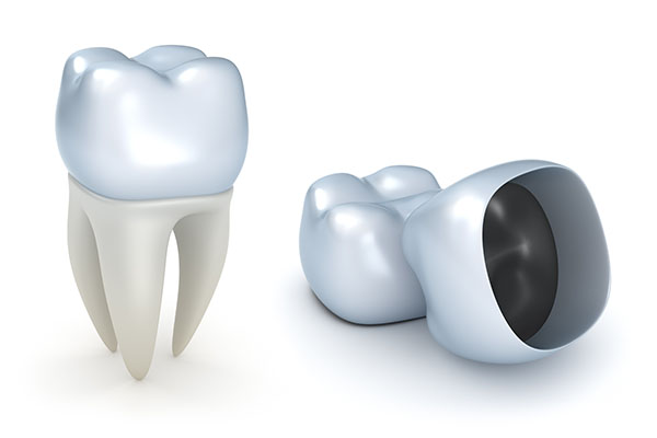 How Dental Crowns Are Bonded To A Tooth