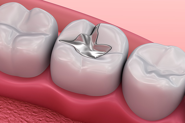 Understanding A Silver Versus Tooth Colored Dental Filling