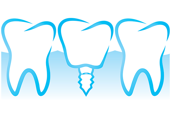 Dental Implant Oral Surgery Procedure &#    ; Commonly Asked Questions