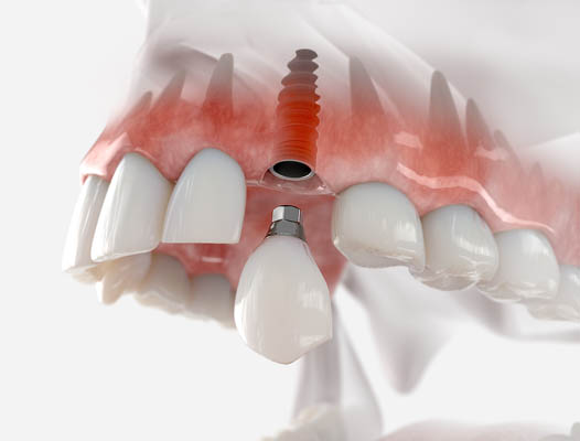 Steps In A Dental Implant Procedure For A Missing Tooth