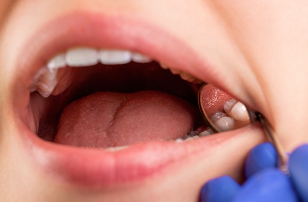 Benefits Of Dental Implants Compared With Traditional Dentures