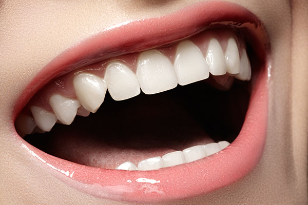 What Are The Differences Between Dental Bonding And Veneers?