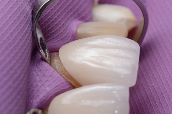 How Are Veneers Used In Cosmetic Dentistry?