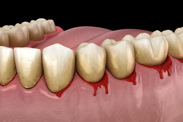 When To See An Emergency Dentist For Gum Problems