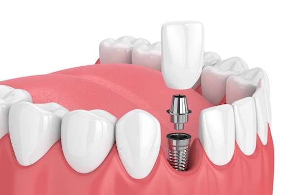 How Painful is Dental Implant Surgery from Sonoran Desert Dentistry in Scottsdale, AZ