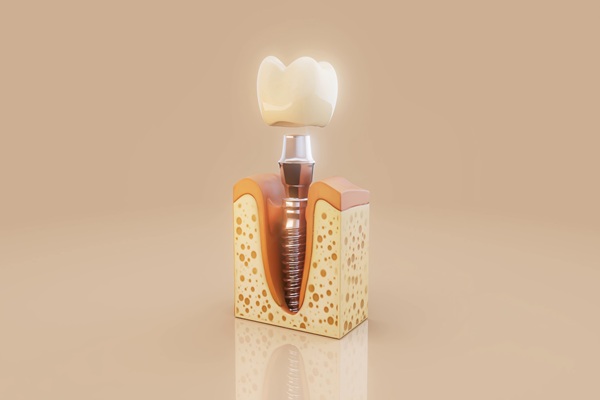 Dental Implants Step By Step: Procedure And Recovery