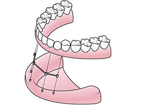 Implant Supported Dentures Scottsdale, AZ | Implant Dentures Near Me