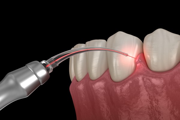 How Laser Dentistry Can Improve Your Smile