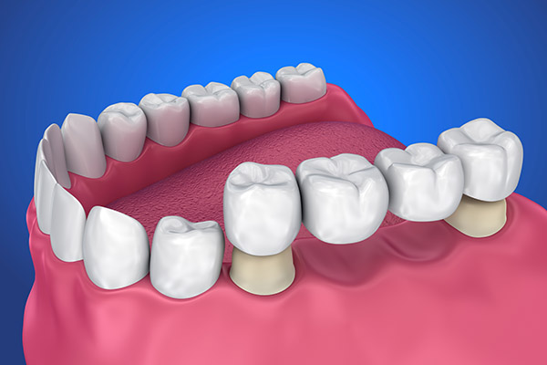 Several Methods of Teeth Repair