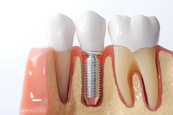 Missing Teeth? The Successful Tooth Replacement Options