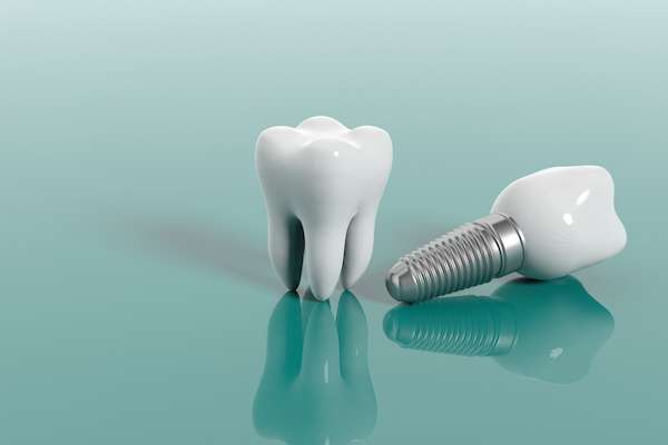 Questions to Ask Your Implant Dentist from Sonoran Desert Dentistry in Scottsdale, AZ