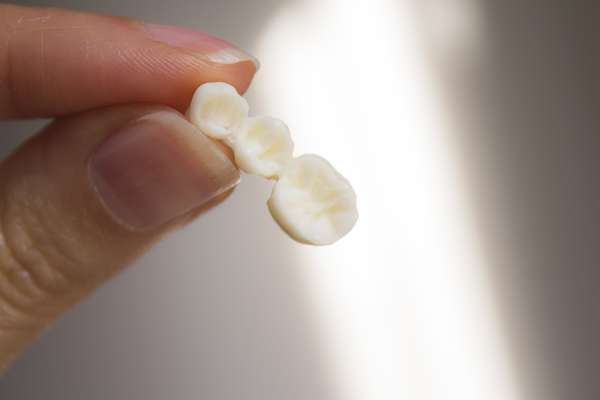 Replace Missing Teeth with Dental Bridges from Sonoran Desert Dentistry in Scottsdale, AZ