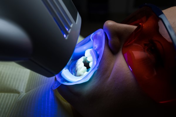 Teeth Whitening: In Office Vs  At Home &#    ; Which Gives Better Results?