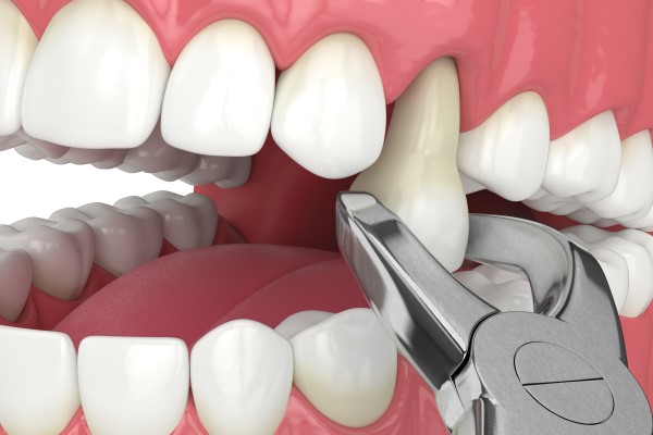Common Signs You May Need A Tooth Extraction