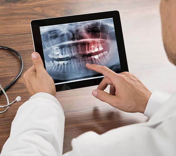 Scottsdale Types of Dental Root Fractures