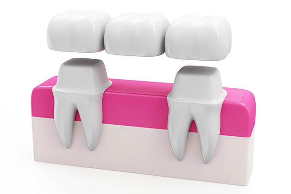 Why Choose a Bridge Option to Replace Missing Teeth from Sonoran Desert Dentistry in Scottsdale, AZ